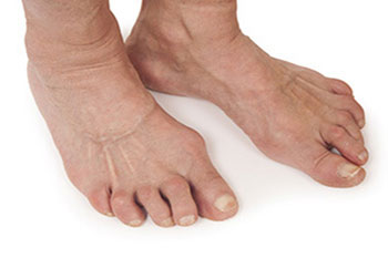 Arthritic foot care in the Manatee County, FL: Bradenton (University Park, Bayshore Gardens, Palmetto, Foxleigh, Lakewood Ranch, Ellenton, Parrish) and Sarasota County, FL: Sarasota (South Gate Ridge, Sarasota Springs, Venice, Laurel, Osprey, Fruitville, South Sarasota, North Sarasota, Southgate, Bee Ridge) areas