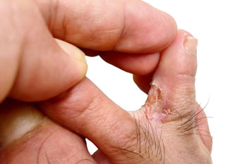 Athletes foot treatment in the Manatee County, FL: Bradenton (University Park, Bayshore Gardens, Palmetto, Foxleigh, Lakewood Ranch, Ellenton, Parrish) and Sarasota County, FL: Sarasota (South Gate Ridge, Sarasota Springs, Venice, Laurel, Osprey, Fruitville, South Sarasota, North Sarasota, Southgate, Bee Ridge) areas
