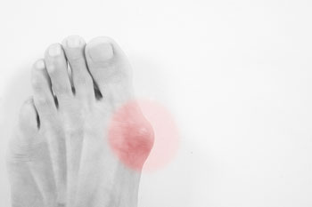 Bunions Treatment in the Manatee County, FL: Bradenton (University Park, Bayshore Gardens, Palmetto, Foxleigh, Lakewood Ranch, Ellenton, Parrish) and Sarasota County, FL: Sarasota (South Gate Ridge, Sarasota Springs, Venice, Laurel, Osprey, Fruitville, South Sarasota, North Sarasota, Southgate, Bee Ridge) areas