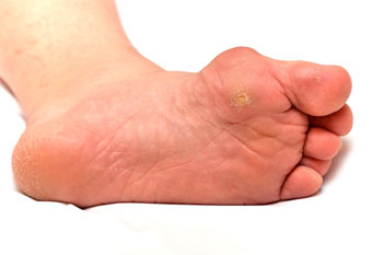 Corns treatment in in the Manatee County, FL: Bradenton (University Park, Bayshore Gardens, Palmetto, Foxleigh, Lakewood Ranch, Ellenton, Parrish) and Sarasota County, FL: Sarasota (South Gate Ridge, Sarasota Springs, Venice, Laurel, Osprey, Fruitville, South Sarasota, North Sarasota, Southgate, Bee Ridge) areas