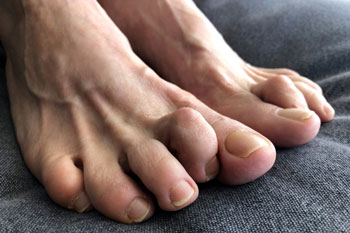 Hammertoes treatment in the Manatee County, FL: Bradenton (University Park, Bayshore Gardens, Palmetto, Foxleigh, Lakewood Ranch, Ellenton, Parrish) and Sarasota County, FL: Sarasota (South Gate Ridge, Sarasota Springs, Venice, Laurel, Osprey, Fruitville, South Sarasota, North Sarasota, Southgate, Bee Ridge) areas