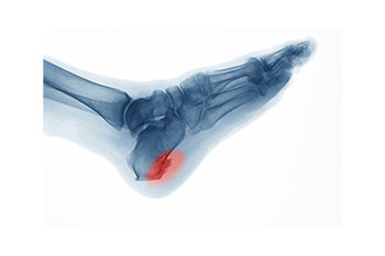 Heel spurs treatment in the Manatee County, FL: Bradenton (University Park, Bayshore Gardens, Palmetto, Foxleigh, Lakewood Ranch, Ellenton, Parrish) and Sarasota County, FL: Sarasota (South Gate Ridge, Sarasota Springs, Venice, Laurel, Osprey, Fruitville, South Sarasota, North Sarasota, Southgate, Bee Ridge) areas