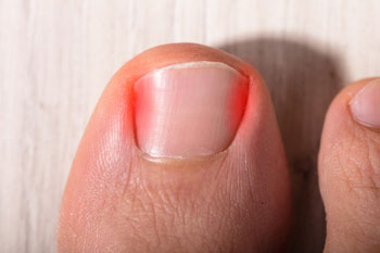 ingrown toenail