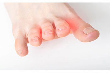 Mortons neuroma treatment in the Manatee County, FL: Bradenton (University Park, Bayshore Gardens, Palmetto, Foxleigh, Lakewood Ranch, Ellenton, Parrish) and Sarasota County, FL: Sarasota (South Gate Ridge, Sarasota Springs, Venice, Laurel, Osprey, Fruitville, South Sarasota, North Sarasota, Southgate, Bee Ridge) areas