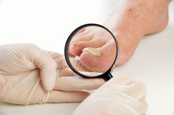 Fungus toenails treatment in in the Manatee County, FL: Bradenton (University Park, Bayshore Gardens, Palmetto, Foxleigh, Lakewood Ranch, Ellenton, Parrish) and Sarasota County, FL: Sarasota (South Gate Ridge, Sarasota Springs, Venice, Laurel, Osprey, Fruitville, South Sarasota, North Sarasota, Southgate, Bee Ridge) areas