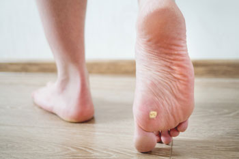 Plantar Warts Treatment in the Manatee County, FL: Bradenton (University Park, Bayshore Gardens, Palmetto, Foxleigh, Lakewood Ranch, Ellenton, Parrish) and Sarasota County, FL: Sarasota (South Gate Ridge, Sarasota Springs, Venice, Laurel, Osprey, Fruitville, South Sarasota, North Sarasota, Southgate, Bee Ridge) areas