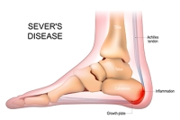 What Every Active Child and Parent Should Know About Sever’s Disease