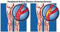 Signs of Peripheral Artery Disease in the Feet